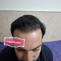 خدمات کاشت مو و ابرو