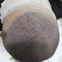 کاشت مو تخصصی در کلینیک فوق تخصصی باقیمت سال گذشته|خدمات آرایشگری و زیبایی|شوشتر, |دیوار