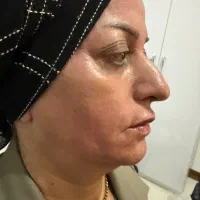 ژل و بوتاکس