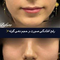 کلاژن مزوتراپی مزونیدلینگ|خدمات آرایشگری و زیبایی|مشهد, کوثر|دیوار