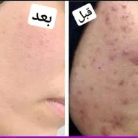 سرم ضدجوش گاتیو