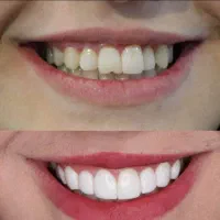 دندانپزشکی و ایمپلنت قسطی