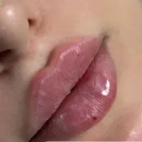 زیبایی چهره هارا ماندگار کن با بوتاکس و فیلر