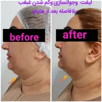 هایفوتراپی،لیفت وجوانسازی صورت،رفع غبغب|خدمات آرایشگری و زیبایی|تهران, ظفر|دیوار