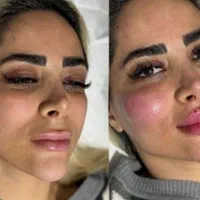 ساکشن چربی و تزریق ژل و بوتاکس و مزو لیفت شقیقه و.|خدمات آرایشگری و زیبایی|کرمانشاه, |دیوار