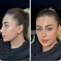 عمل زیبایی بینی