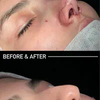 عمل جراحی بینی /لیفت صورت/پلک|خدمات آرایشگری و زیبایی|کرج, عظیمیه|دیوار