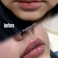 تزریق ژل ،بوتاکس ،لیزر موهای زائد، ساکشن غبعب|خدمات آرایشگری و زیبایی|تهران, صد دستگاه|دیوار