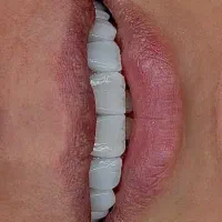 آموزش کامپوزیت دندان