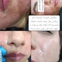 پی ارپی صورت ومو ومزوتراپی صورت ومو تخفیف ویژه|خدمات آرایشگری و زیبایی|کازرون, |دیوار
