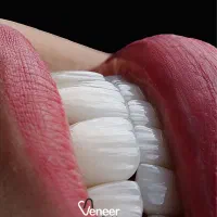 دندانپزشکی کامپوزیت ایمپلنت لمینت (بدون تراش)|خدمات آرایشگری و زیبایی|تهران, زعفرانیه|دیوار