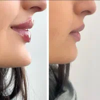 لیزرموهای زائد فول دست پا صورت ژل فیلربادی بوتاکس|خدمات آرایشگری و زیبایی|کرج, گوهردشت|دیوار