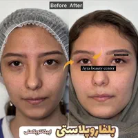 بلفاروپلاستی-سانترال لب-بوکال فت-ساکشن غبغب