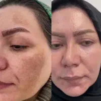 جشنواره درمان کک ومک/لک/خال/ریزش مودریک جلسه