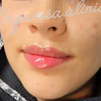 تزریق فیلر ، بوتاکس لیزر موهای زائد