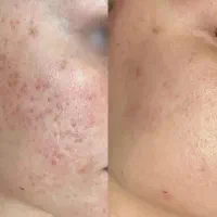 تضمینی لکه هاتو نابود کن