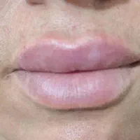 جشنواره تخفیف تزریق تخصصی ژل و بوتاکس|خدمات آرایشگری و زیبایی|شیراز, محراب|دیوار