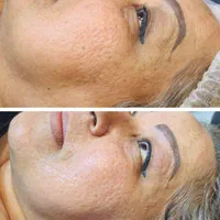 فیشیال مزوتراپی الکترولیز پاکسازی و آموزش در مطب|خدمات آرایشگری و زیبایی|اهواز, گلستان|دیوار