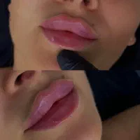 فیلر ژل بوتاکس تخصصی فیلرلب فیلرچونه زاویه فک