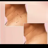 برداشت خال و لک|خدمات آرایشگری و زیبایی|تهران, گیشا|دیوار