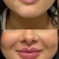 لیزر مو های زایددستگاه کندلا (شاتی ) بهترین۲۰۲۵|خدمات آرایشگری و زیبایی|کرج, احدآباد|دیوار