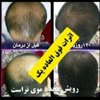 درمان قطعی و تضمینی ریزش شدید مو ( مقطعی و سکه ای)|آرایشی، بهداشتی، درمانی|رشت, حاجی آباد|دیوار