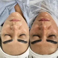 آفر ویژه ی فیشال و پاکسازی پوست بانوان و آقایان