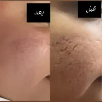 مدل فیشیال وی ای پی و درمان جوش|خدمات آرایشگری و زیبایی|تهران, مجیدیه|دیوار