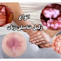درمان زگیل تناسلی