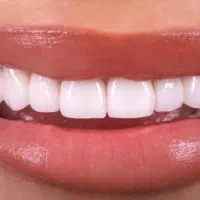 دندانپزشکی به مدت یکماه پنجاه درصد تخفیف
