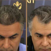 لیدر کاشت مو