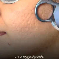 درمان جای بخیه اسکار جای جوش و ..