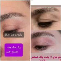 حذف چروک و کک و مک  بدون جراحی