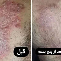در.مان پسوریازیس