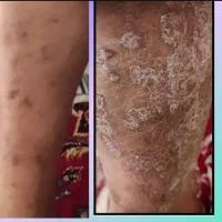 مشکلات پوستی و گرمای بدن