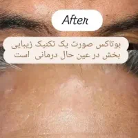 تزریق ژل فقط سیسی ۸۰۰بمدت سه روز|خدمات آرایشگری و زیبایی|زاهدان, |دیوار