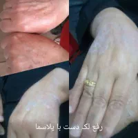 مزونیدلینگ کل صورت و پاکسازی وخالبرداری وآموزش