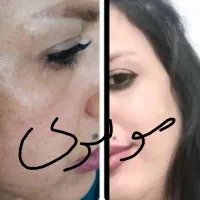 روشن کننده و رفع هرنوع مشکل پوستی بدون بازگشت|آرایشی، بهداشتی، درمانی|لردگان, |دیوار