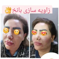 لیزر|خدمات آرایشگری و زیبایی|گلبهار, شهر جدید گلبهار|دیوار