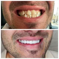 دندانپزشکی کامپوزیت لمینت