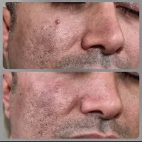 حذف خال و زگیل و رفع جای جوش و حفرات با تخفیف|خدمات آرایشگری و زیبایی|تهران, بیسیم|دیوار