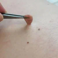 لیزر منگوله های گوشتی خال زگیل