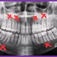 عصب کشی رایگان دندانپزشکی