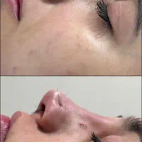 اف عمل زیبایی بینی|خدمات آرایشگری و زیبایی|دهدشت, |دیوار