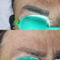 ریموو تتو و رفع تیرگی بدن در مطب پزشک|خدمات آرایشگری و زیبایی|آبادان, |دیوار