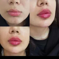 تزریق ژل|خدمات آرایشگری و زیبایی|بندر گناوه, |دیوار