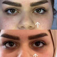 تزریق وآموزش ژل و بوتاکس چربی توسط دانشجویی پزشکی|خدمات آرایشگری و زیبایی|اهواز, زیتون کارمندی|دیوار