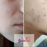 کاهش سایز وچربی سوزی|آرایشی، بهداشتی، درمانی|تربت‌حیدریه, کلاته توکلی|دیوار