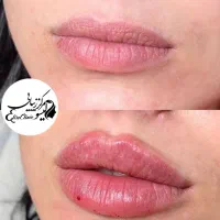 کلینیک تزریق فیلر بوتاکس لیزر هایفو فشیال مزو خال|خدمات آرایشگری و زیبایی|تهران, نیروی هوایی (پیروزی)|دیوار