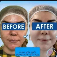 هایفوتراپی صورت ،رفع غبغب ،لاغری امبدینگ،خالبرداری|خدمات آرایشگری و زیبایی|شهر بابک, |دیوار